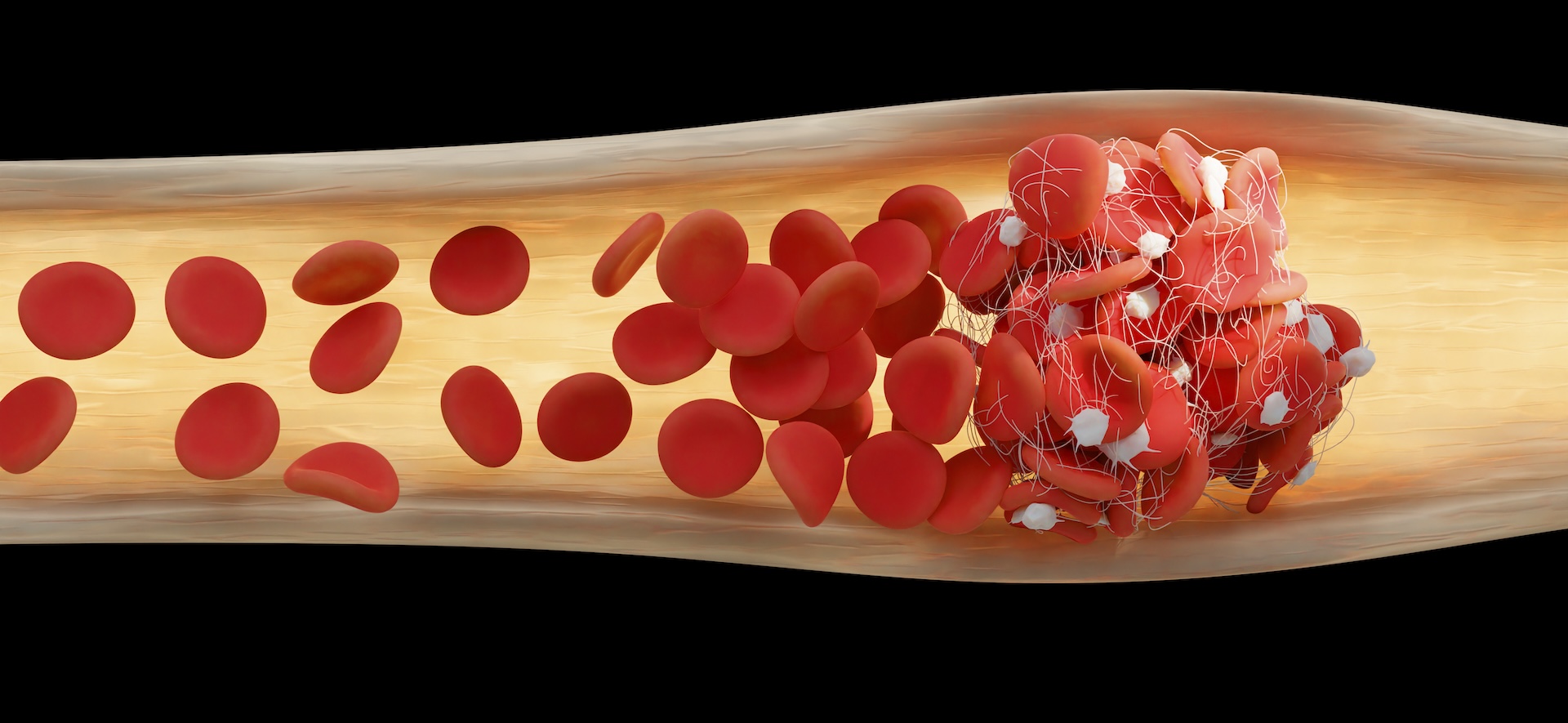 An illustration showing how red blood cells get caught in a blood vessel.