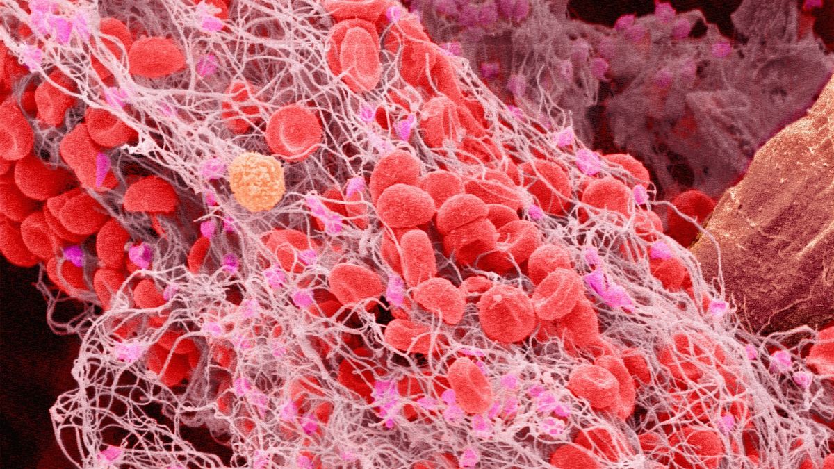 What causes blood clots? | Keep Science