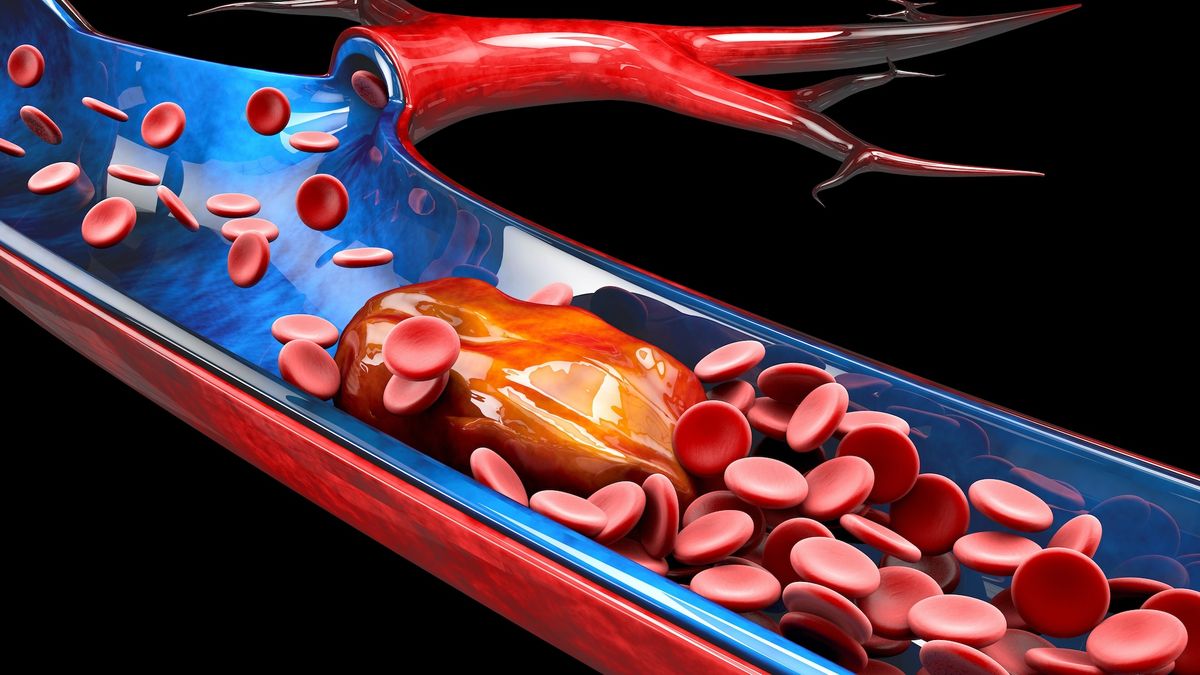 Nervousness and despair improve the hazard of dangerous blood clots, analysis finds